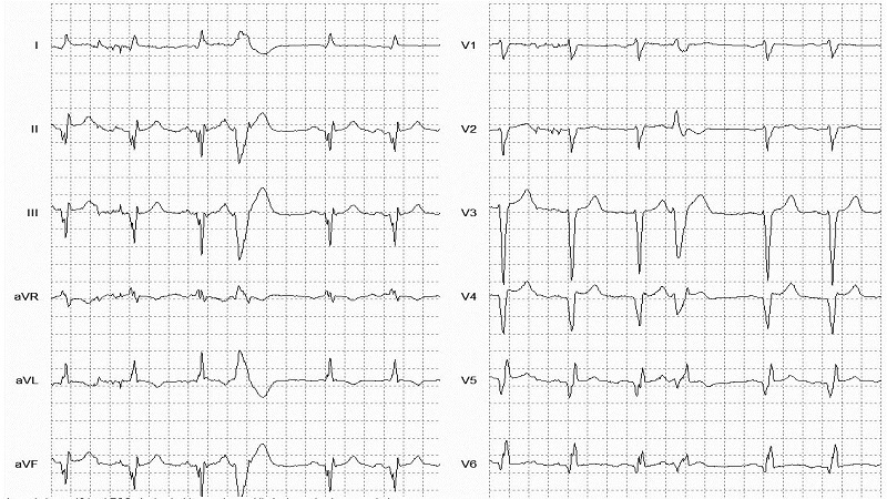 VEB Unspecified Morphology 12 Lead EKG